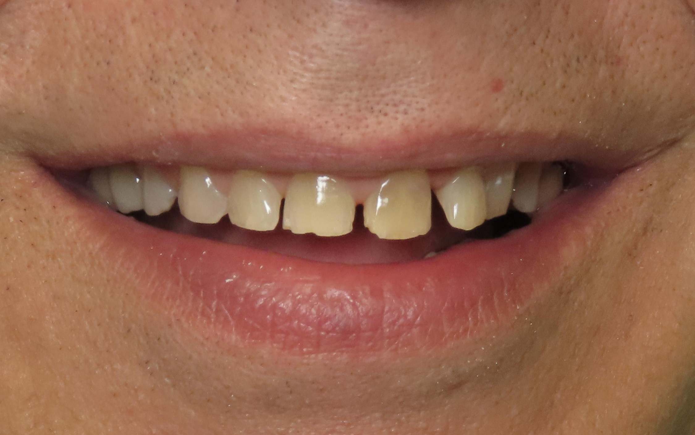 full mouth reconstruction cosmetic dentistry