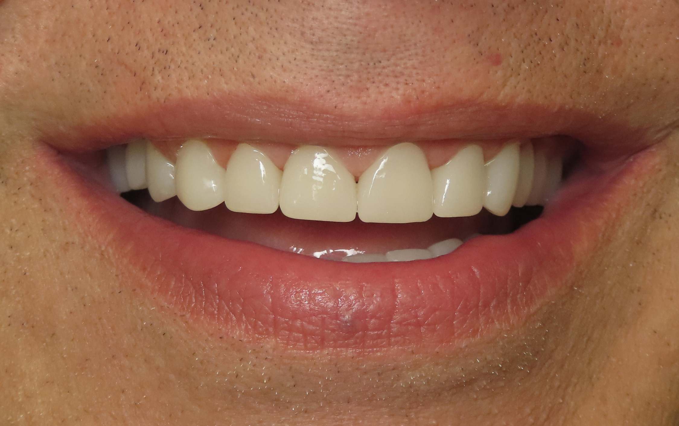 full mouth reconstruction cosmetic denstistry