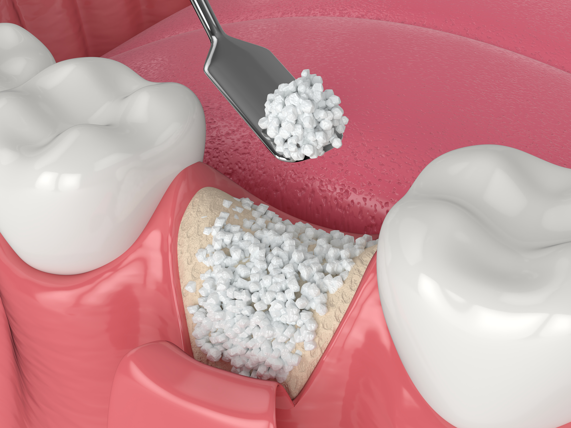 bone graft