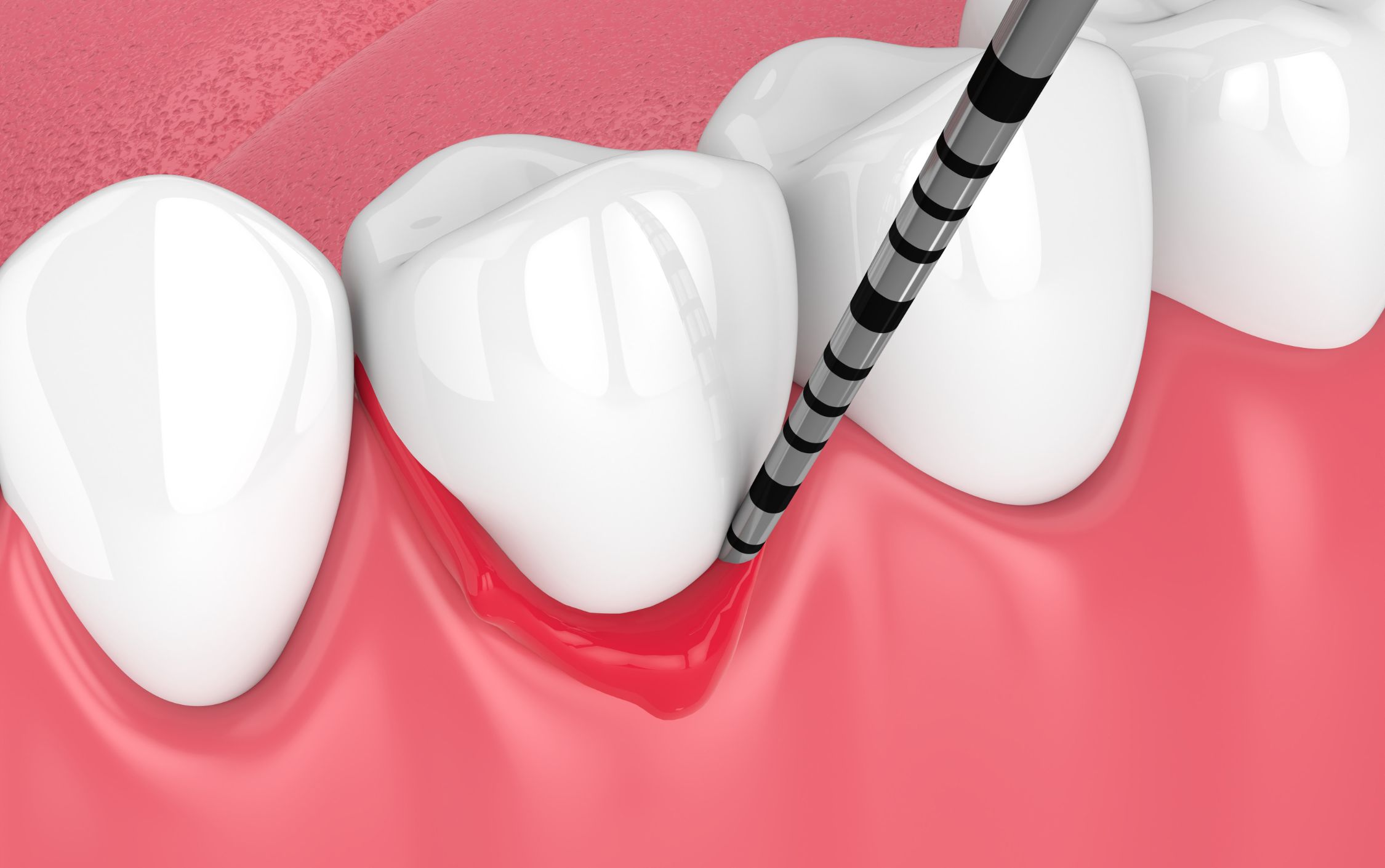 gum measurement dental cleaning