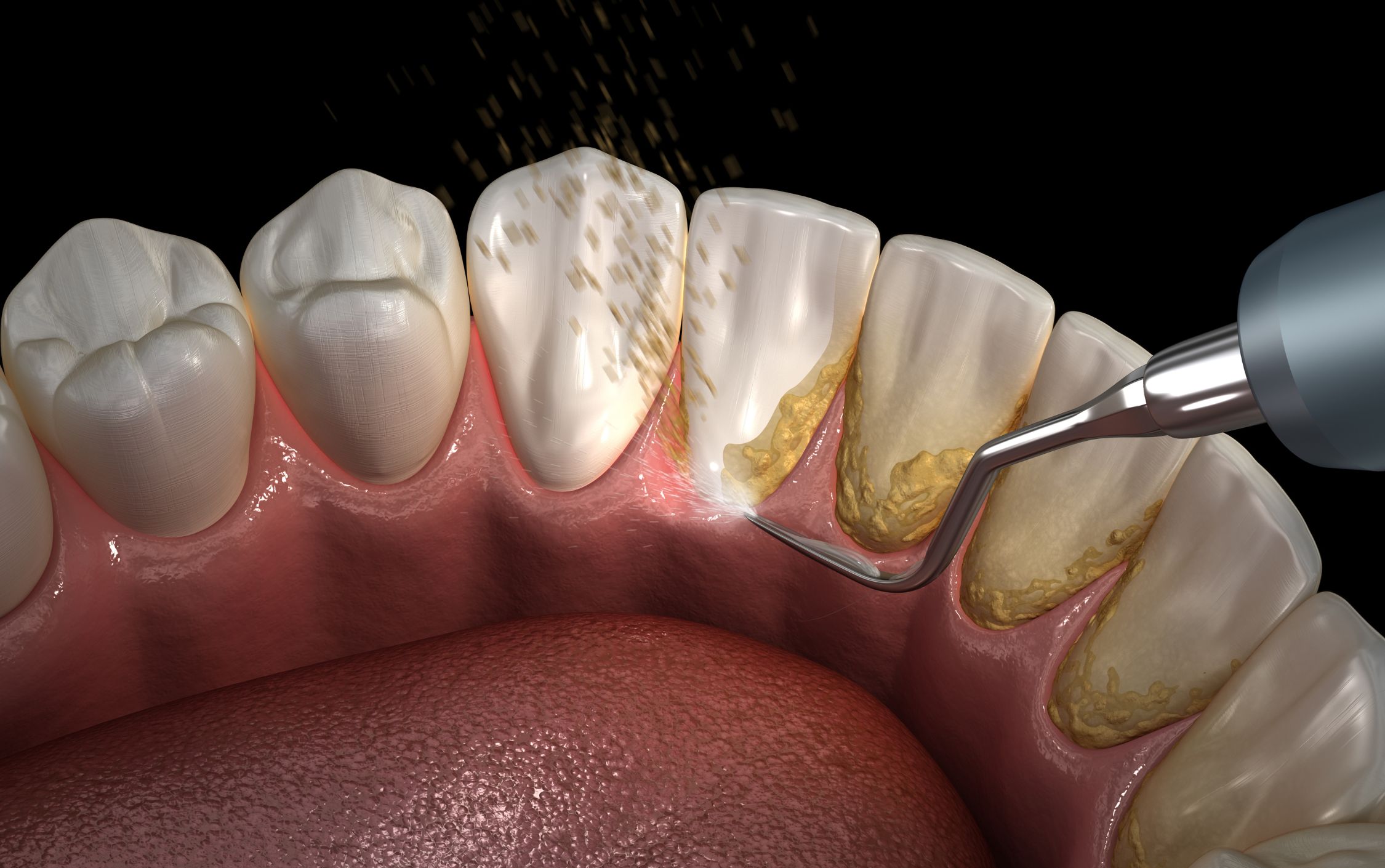 remove tartar dental cleaning