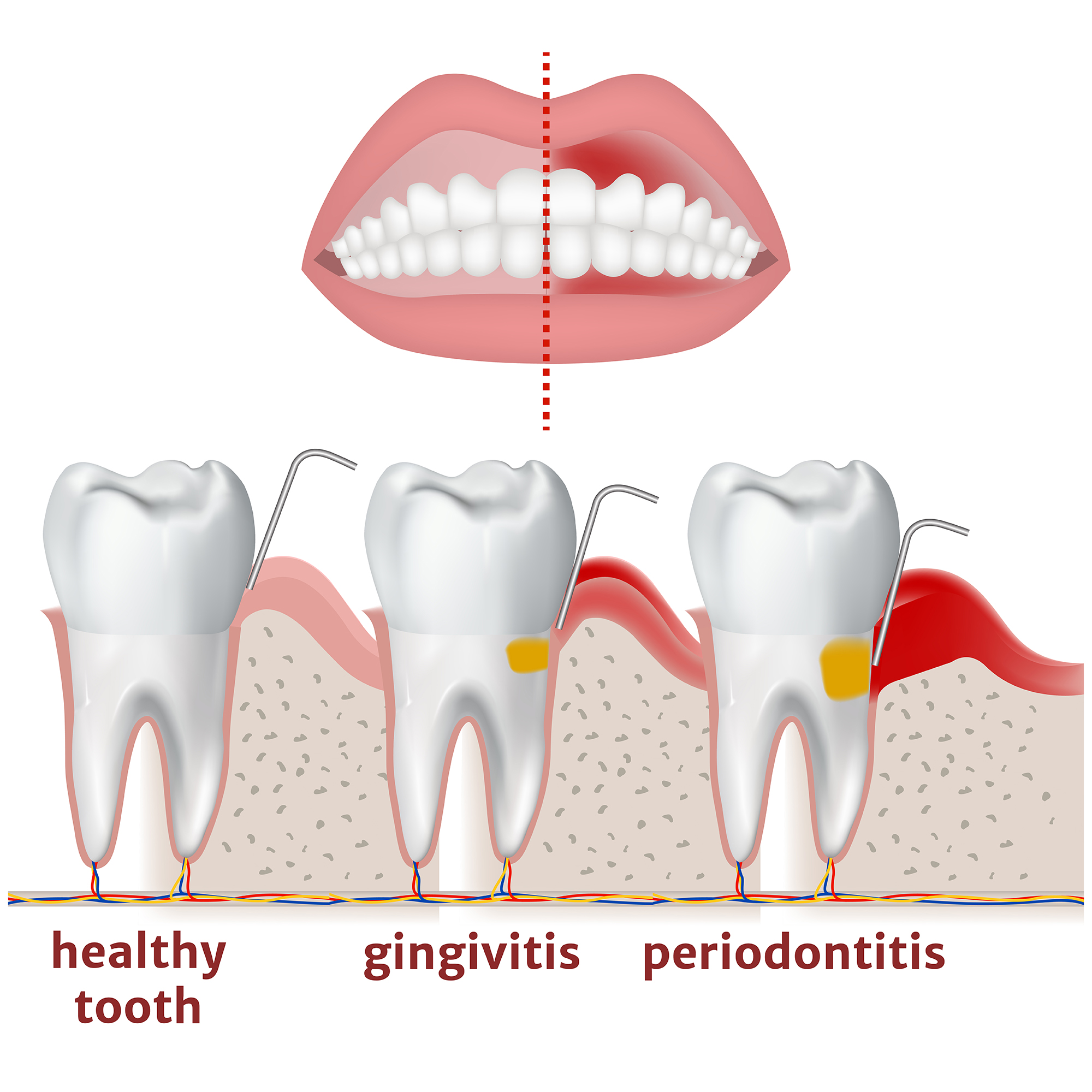 image shows how dental deep cleanings help stop the progress of periodontal disease