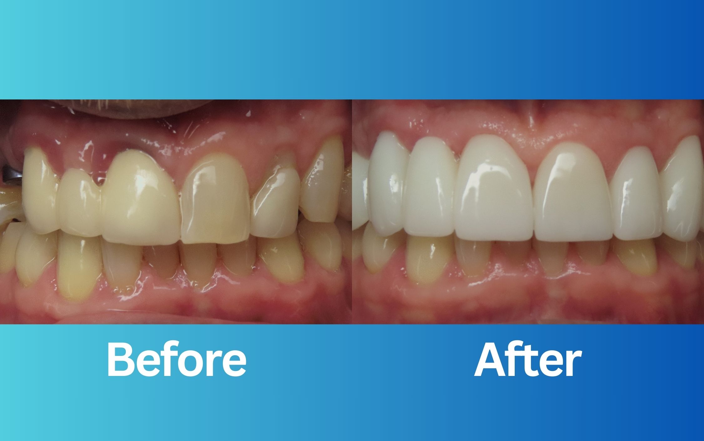 smile makeover before and after