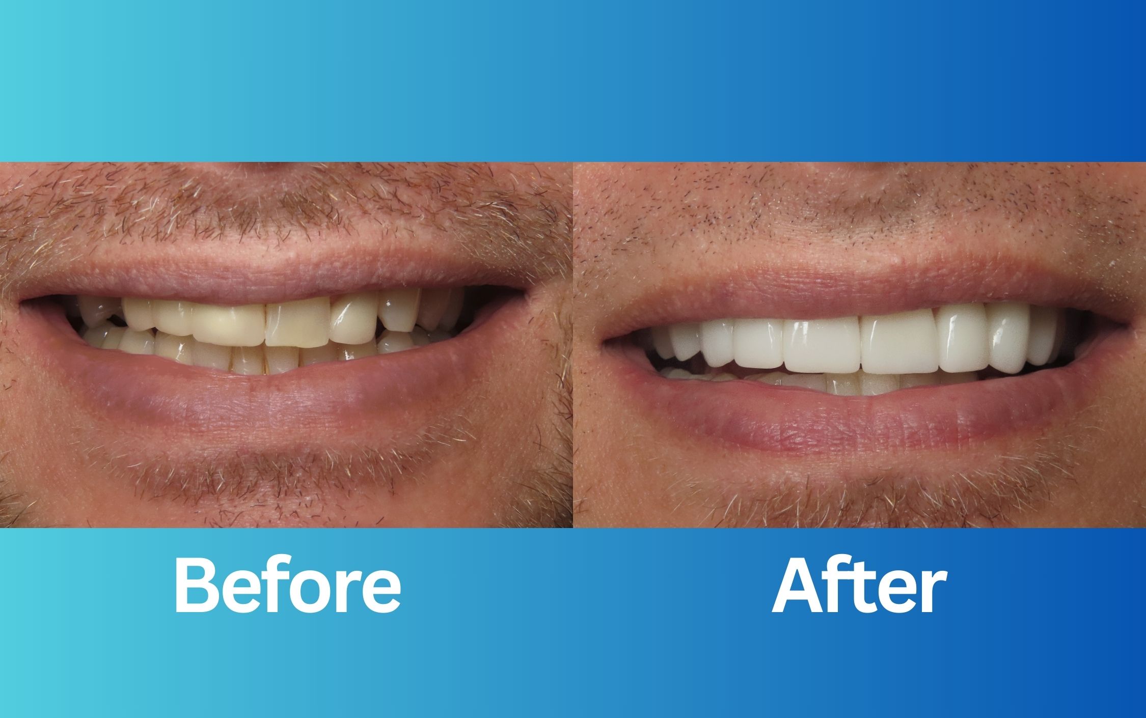 smile makeover before and after