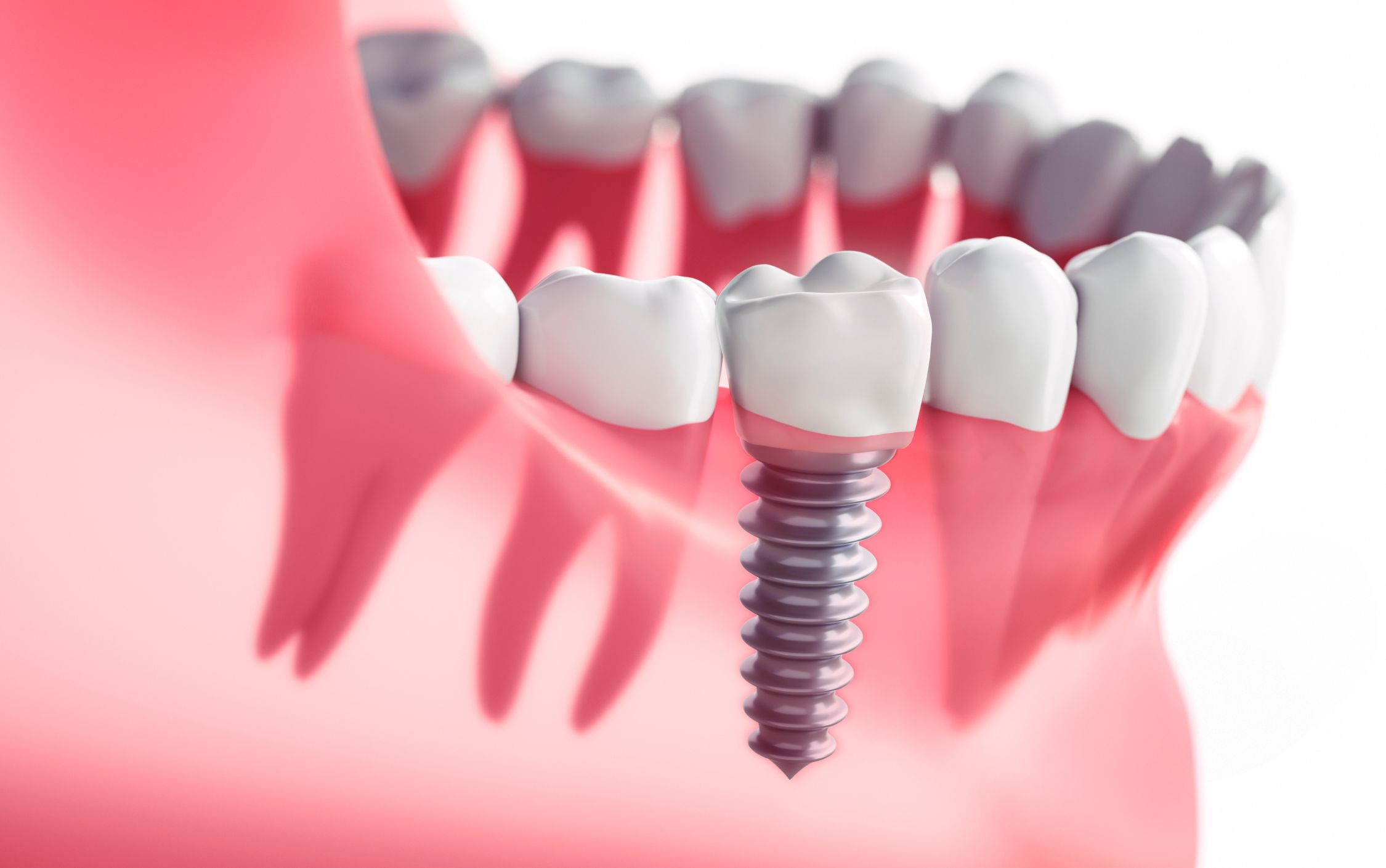 dental implant candidate