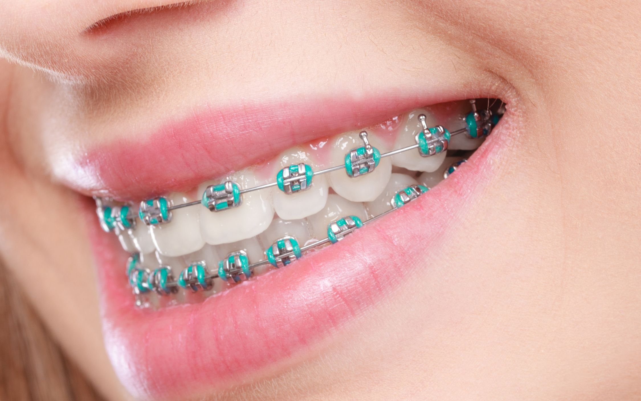 adult orthodontics teeth straightening teeth shifting